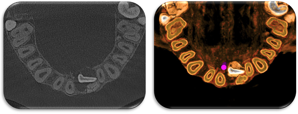 Figura 3: Corte axial a nivel incisal