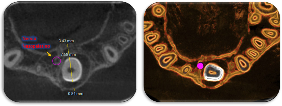 Figura 4: Corte axial a nivel cervical