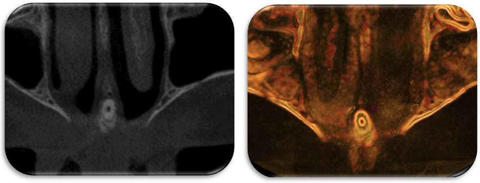 Figura 5: Corte axial a nivel apical