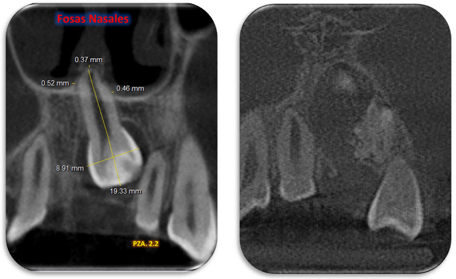 Figure 6: Corte Coronales