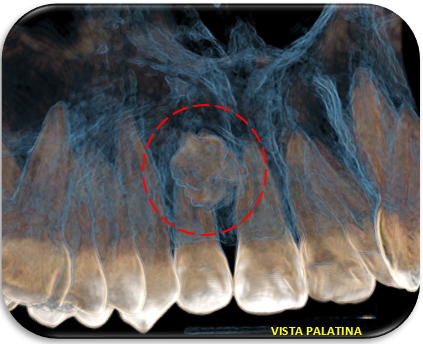 HALLAZGOS TOMOGRAFICOS