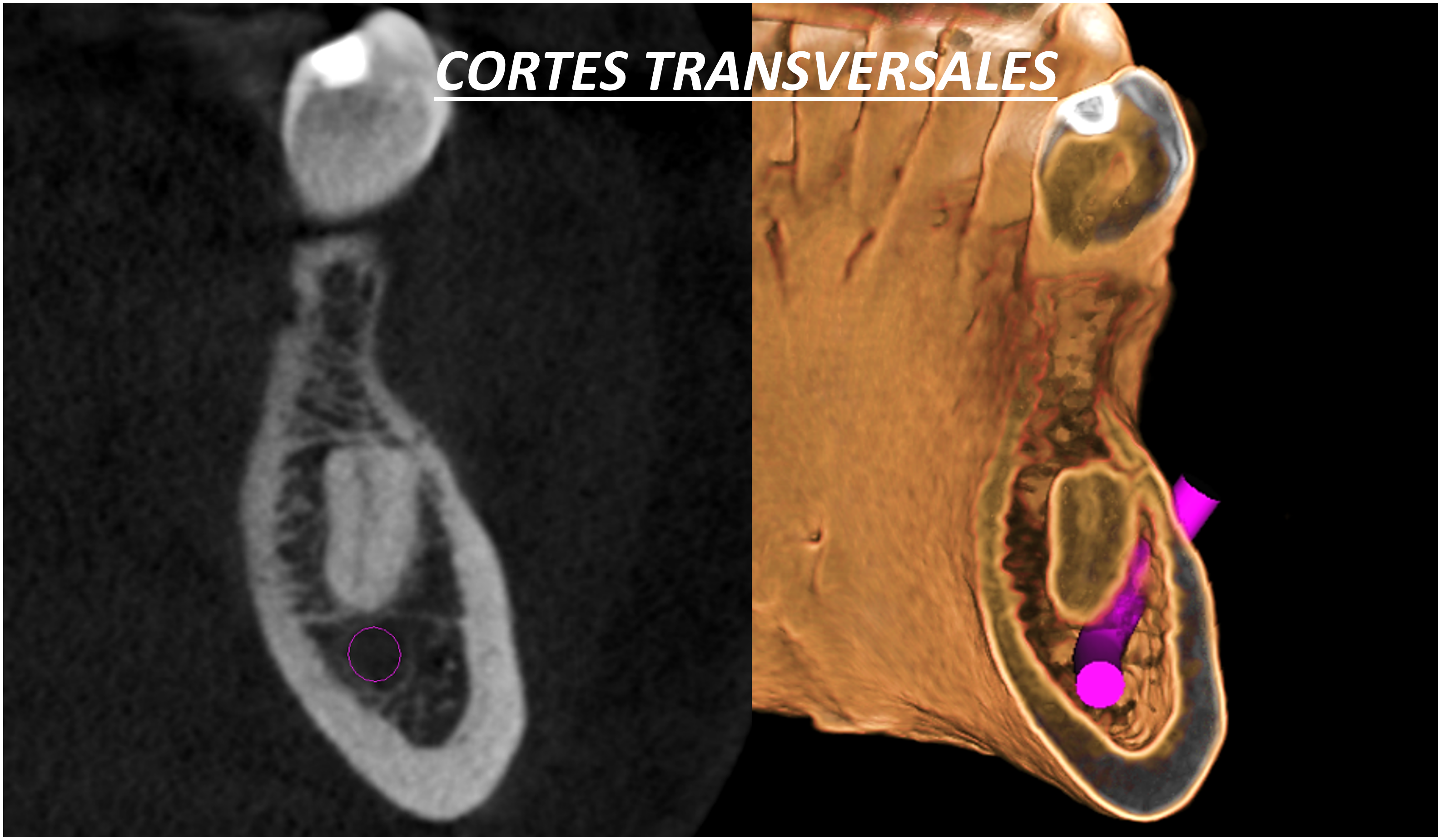 Cortes transversales