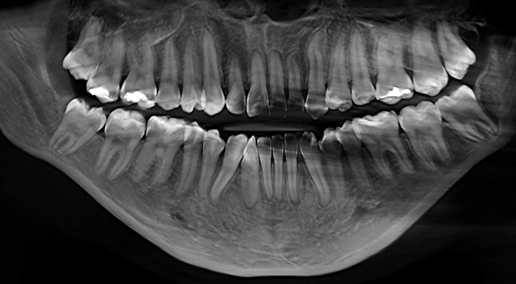TERCER MOLAR INFERIOR INCLUIDO CON FENESTRACIÓN CORTICAL LINGUAL 