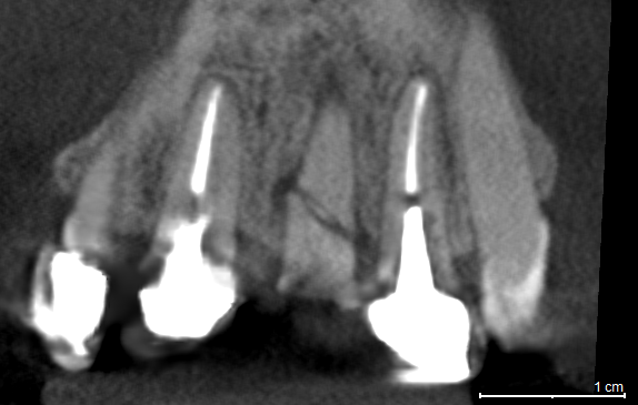 PRESENCIA DE MESIODENS CON DENS INVAGINATUS