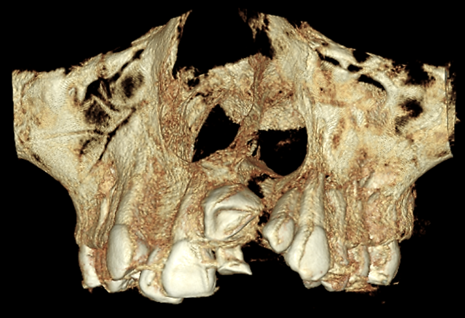 EVALUACIÓN IMAGENOLÓGICA EN PACIENTE CON FISURA PALATINA ALVEOLAR – Enfoque tomográfico para planificación en Cirugía Maxilofacial