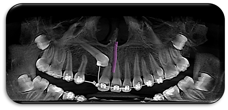 Evaluación imagenológica de geminación dental en paciente en tratamiento de ortodoncia
