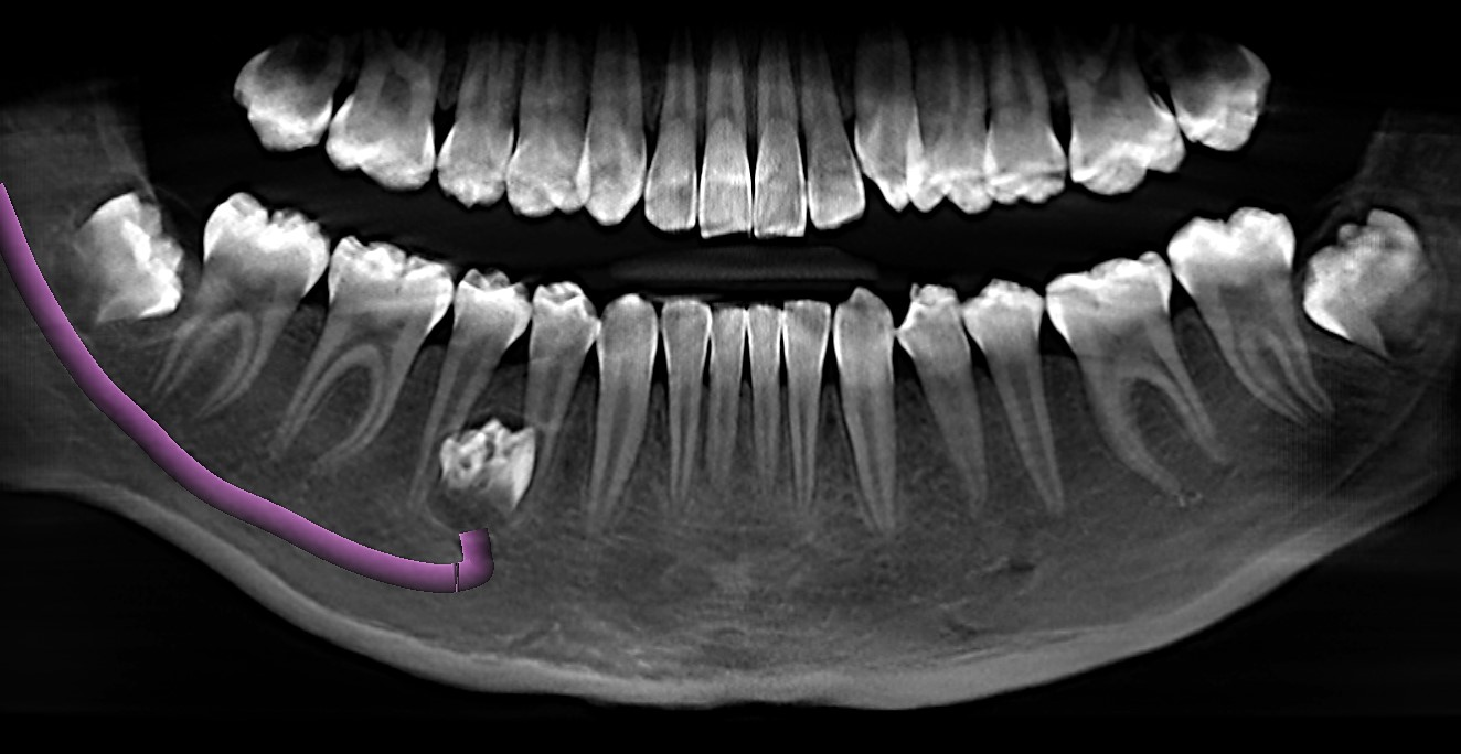 LOCALIZACIÓN DE ODONTOMA ENTRE PIEZAS 4.4 Y4.5 