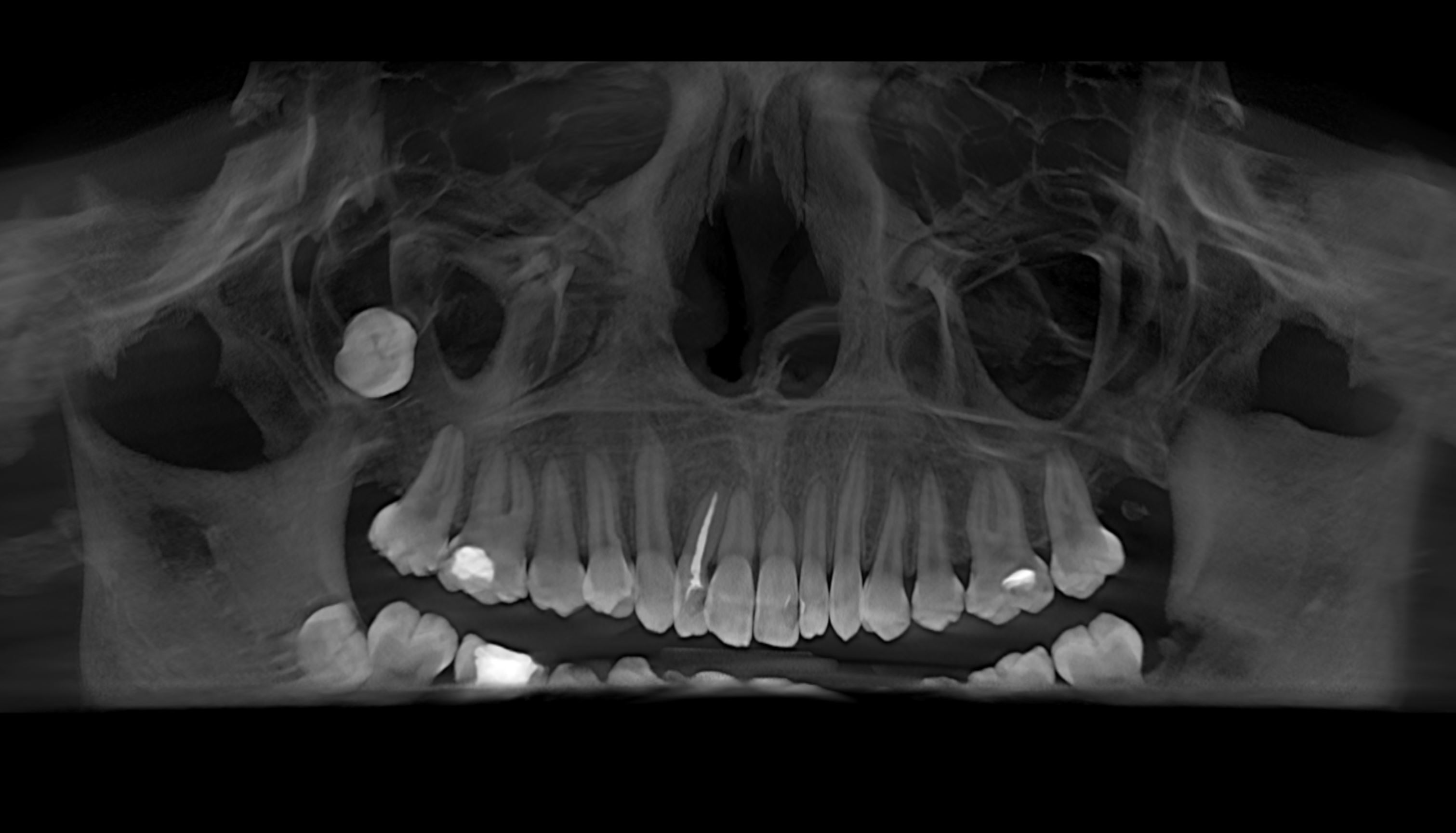 DESPLAZAMIENTO DE TERCER MOLAR SUPERIOR AL SENO MAXILAR