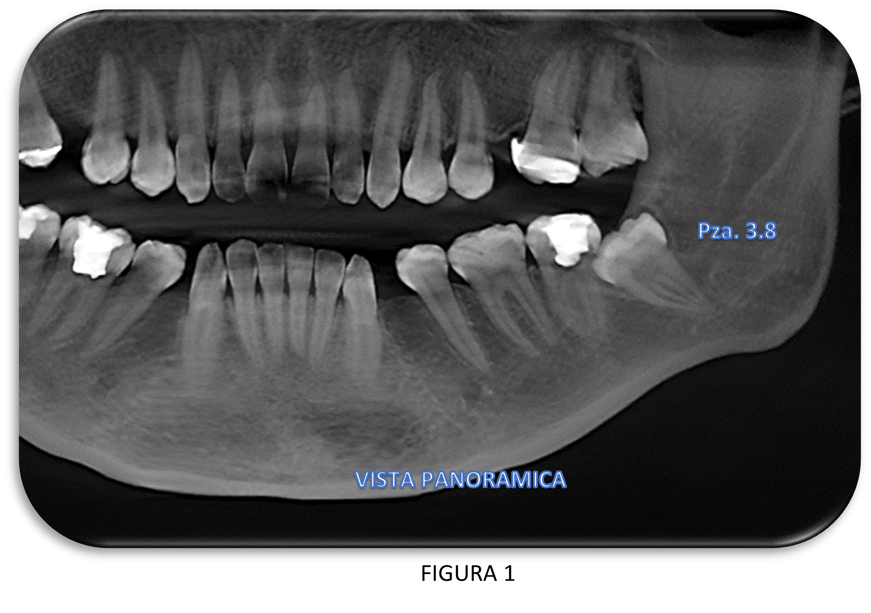 Importancia de la Tomografía  previa en Cirugía Oral 