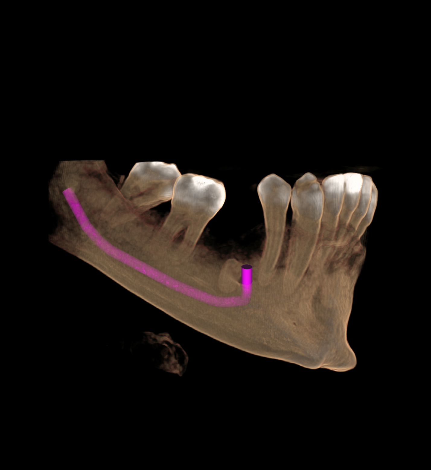 HALLAZGO DE RESTO RADICULAR TOMOGRAFIA CONE BEAM