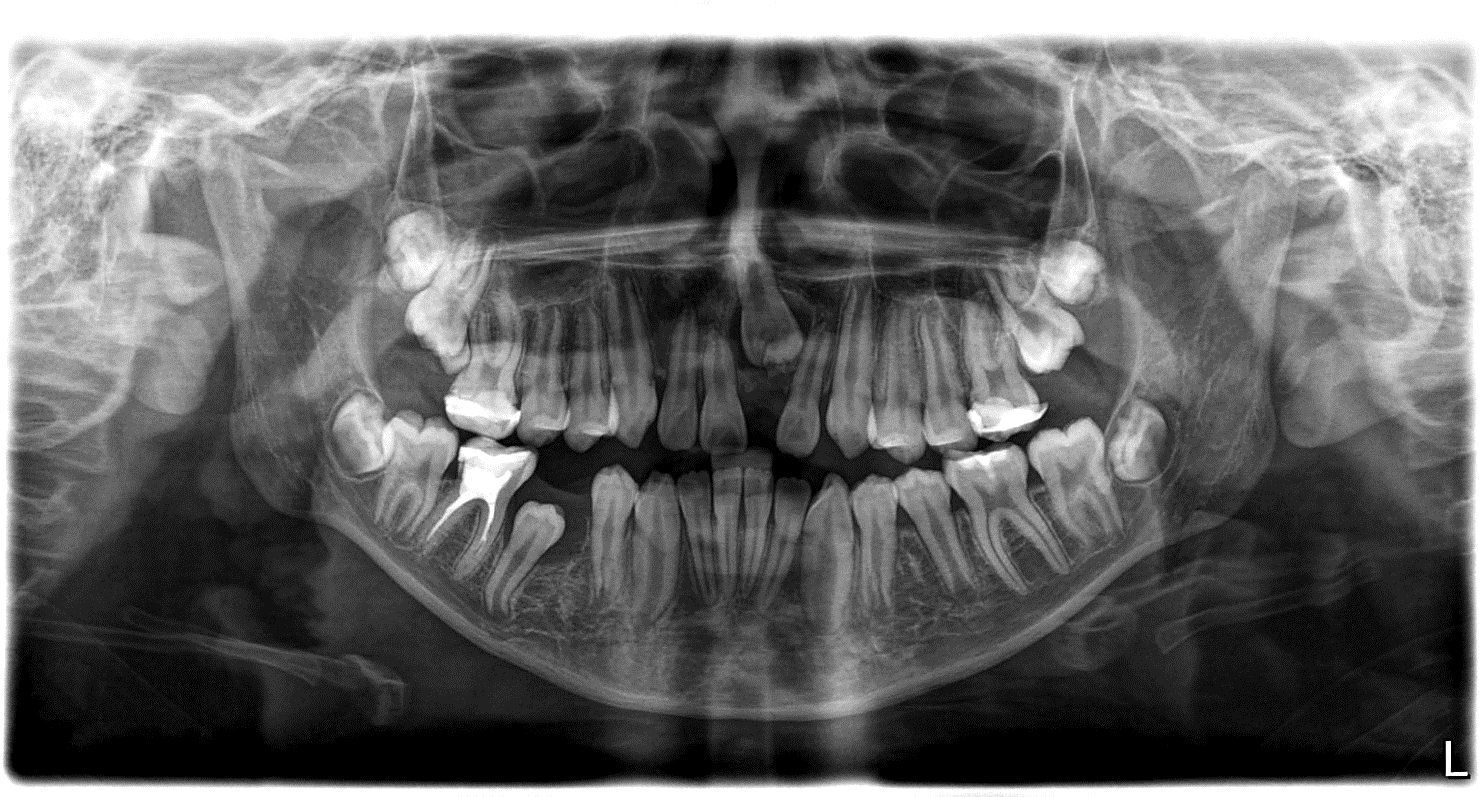 Caso Clínico #5: Odontoma Complejo