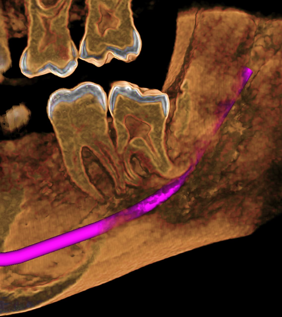 TERCER MOLAR INFERIOR IZQUIERDO RETENIDO CON DILACERACIÓN RADICULAR Y RELACIÓN CON EL NERVIO DENTARIO INFERIOR