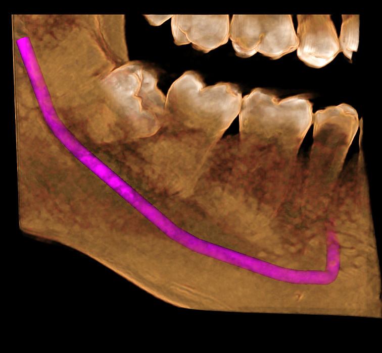 Evaluación tomográfica del nervio dentario inferior para la planificación quirúrgica de terceros molares