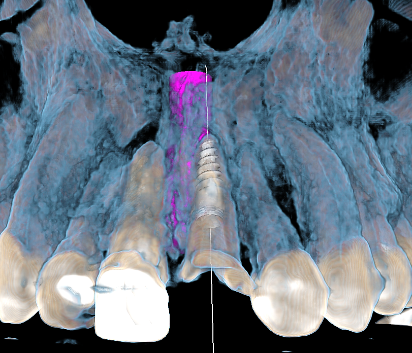 ESTUDIO TOMOGRAFICO PLANIFICACION DE IMPLANTES 