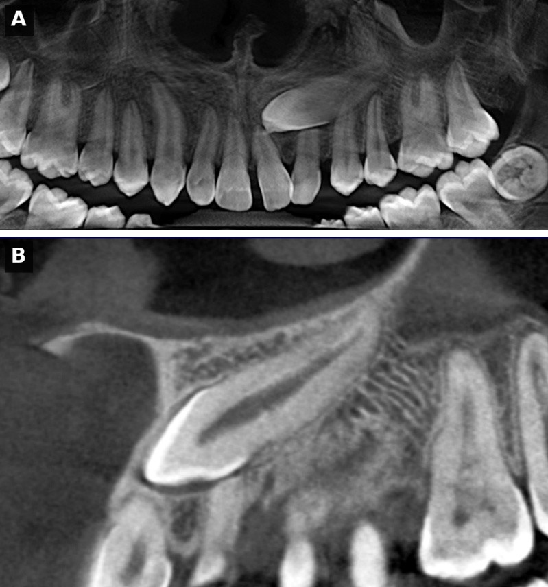 Análisis tomográfico e Importancia de la planificación quirúrgica en el canino superior