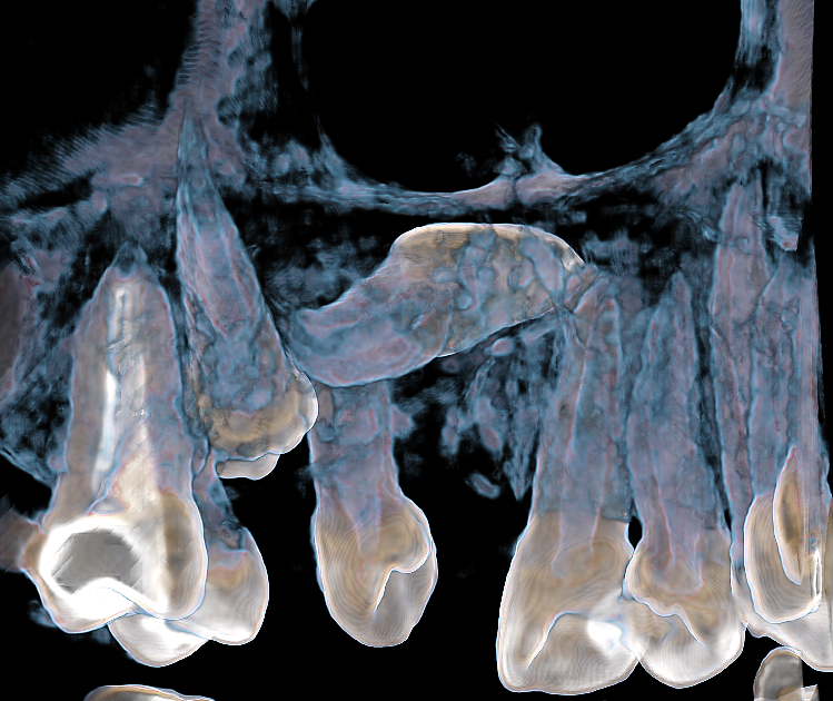 INCLUSIÓN ECTÓPICA SIMULTÁNEA DE LAS PIEZAS 2.1 Y 2.3 CON DILACERACIÓN RADICULAR EVALUADA MEDIANTE CBCT