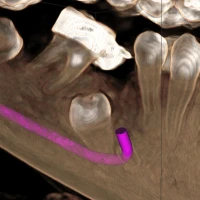 LOCALIZACION DE IMPACTACION DE PREMOLAR INFERIOR PARA ORTODONCIA