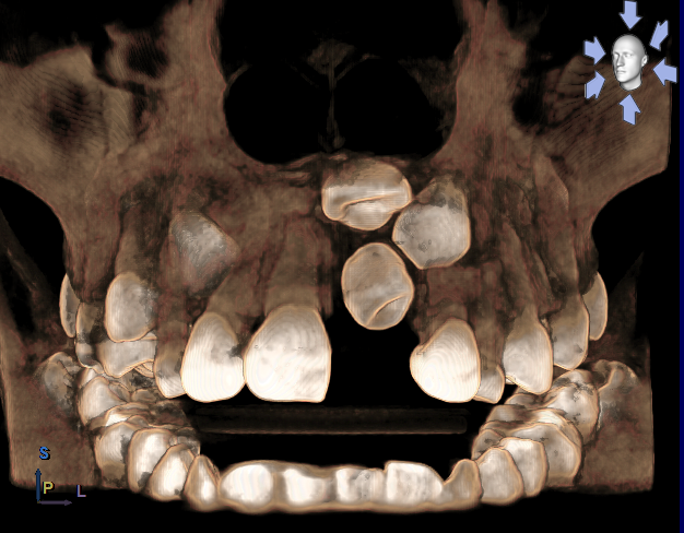 PRESENCIA DE MESIODENS CON DENS INVAGINATUS