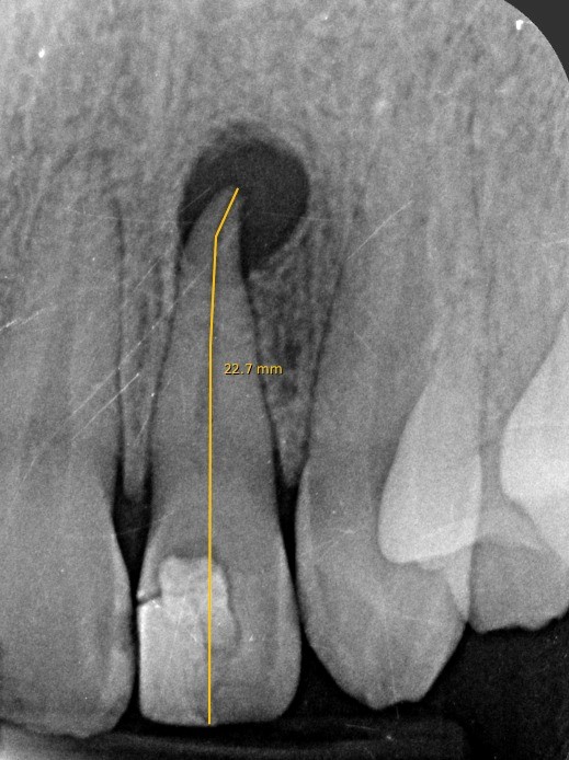 EVALUACIÓN IMAGENOLÓGICA DE LESIÓN PERIAPICAL COMPATIBLE CON QUISTE RADICULAR