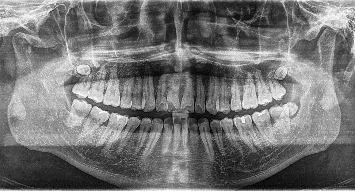 Caso Clínico #2: Cuarto Molar